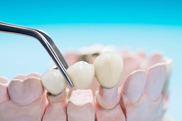an image showing how dental bridges are put on the teeth