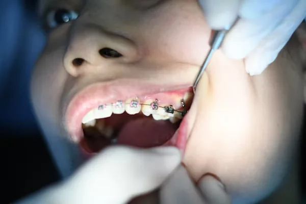 close-up shot of a teeth with braces during a dental treatment