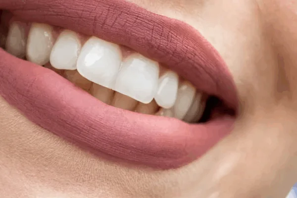image of a woman's perfect teeth