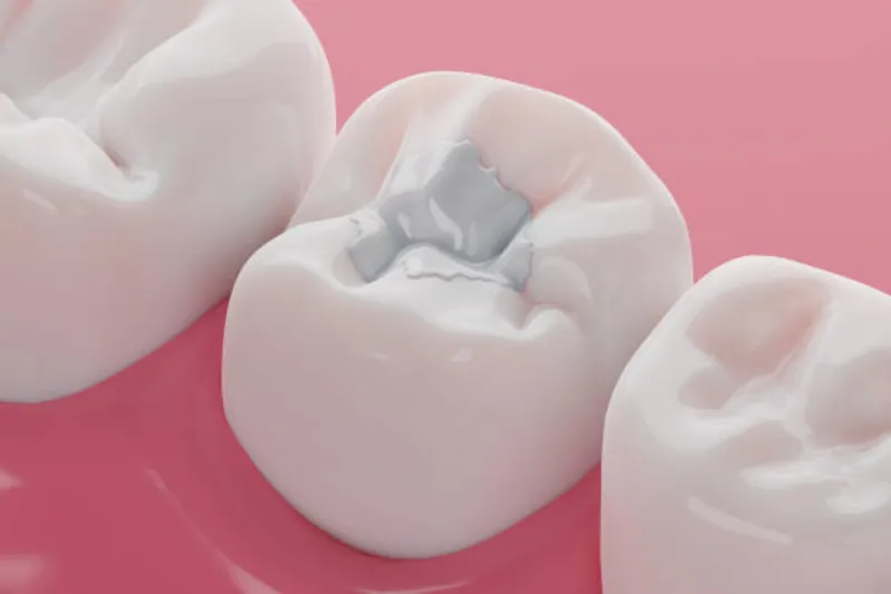 a digital illustration showing dental fillings on teeth