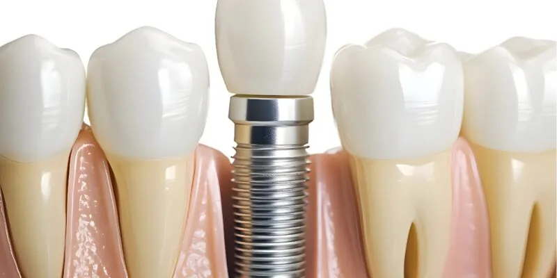 Close-up illustration of a dental implant replacing a missing tooth in the jawbone